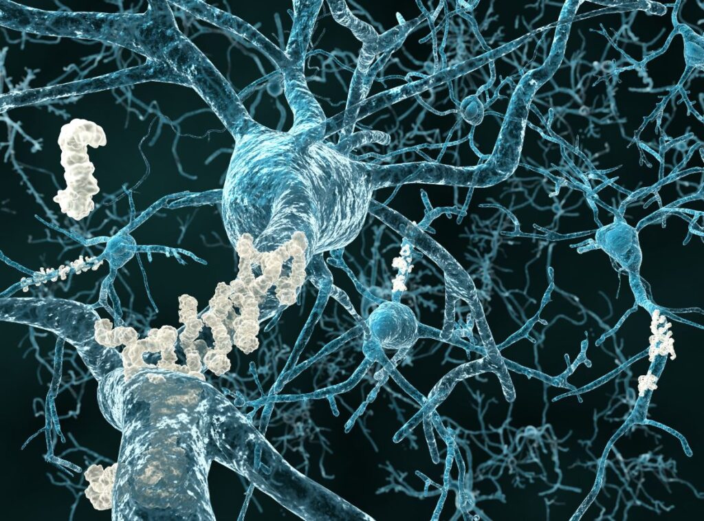 Ligação entre gene comum no Alzheimer e COVID-19