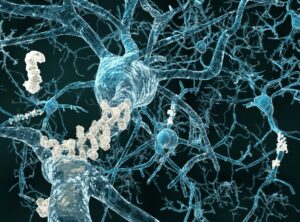 Link between common Alzheimer's gene and COVID-19