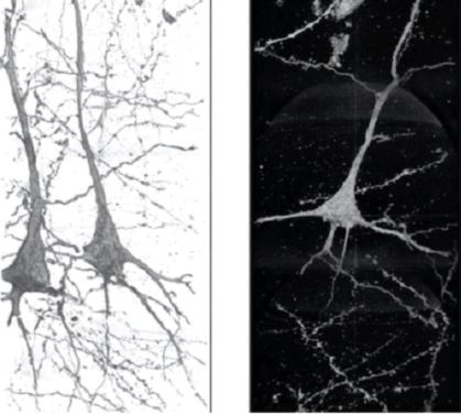 Imagens em 3D de neurônios de paciente com esquizofrenia, obtidas por raios-X e ótica de alta resolução. Mostram neuritos ondulados e distorcidos, o que pode indicar que a condição esteja ligada ao formato dos neurônios.